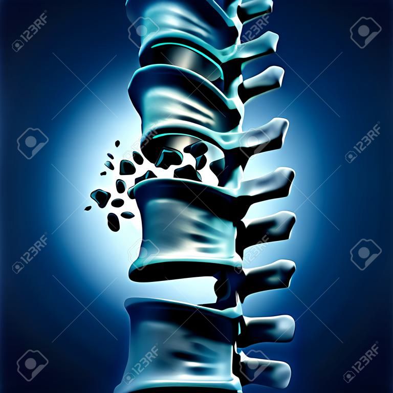 Spinale breuk en traumatische wervelletsel medische concept als een menselijke anatomie wervelkolom met een gebroken gebarsten wervel als gevolg van compressie of andere osteoporose rugziekte.