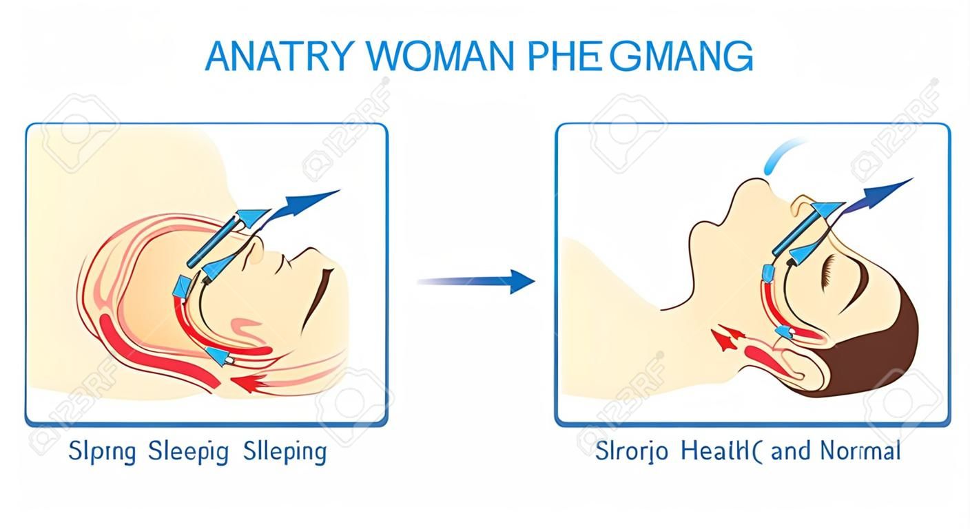 Anatomía de la mujer durante el sueño normal y han ronquidos. Ilustración sobre la asistencia sanitaria y médica