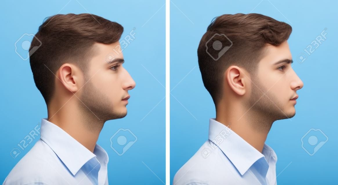 Człowiek z plastyka nosa. Przed i po zdjęcia młodego człowieka z chirurgii plastycznej nosa.
