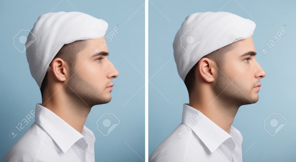 Człowiek z plastyka nosa. Przed i po zdjęcia młodego człowieka z chirurgii plastycznej nosa.