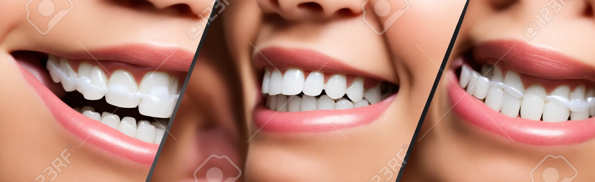 
Collage of braces for correction of human teeth