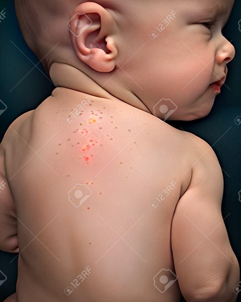 Allergies, pimples on the baby's skin. Food allergy. Skin diseases, symptoms.