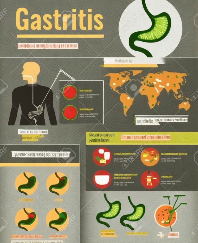Gastritis-Symptome Magengeschwür verursacht Informationen über ungesunde Ernährungsgewohnheiten der Weltbevölkerung betroffene Infografik-Plakatillustration