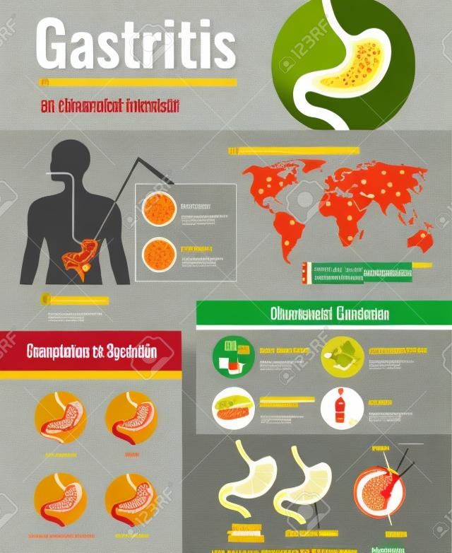 Gastritis-Symptome Magengeschwür verursacht Informationen über ungesunde Ernährungsgewohnheiten der Weltbevölkerung betroffene Infografik-Plakatillustration