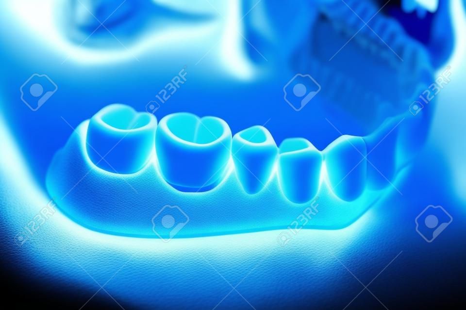 The lower jaw of a man, created on a 3d printer from a photopolymer material. Stereolithography 3D printer, technology of liquid photopolymerization under UV light. Modern medical technologies