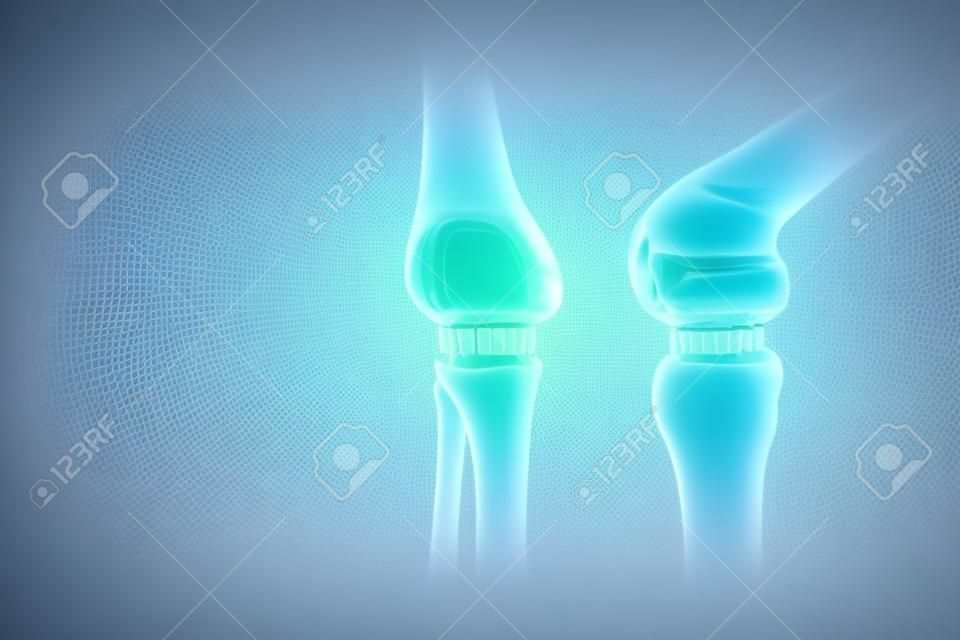 implante de quadril Poster médico, imagem dos ossos do joelho, articulação artificial no joelho. Artrite, inflamação, fratura, cartilagem,. Espaço de cópia, ilustração 3D, renderização 3D