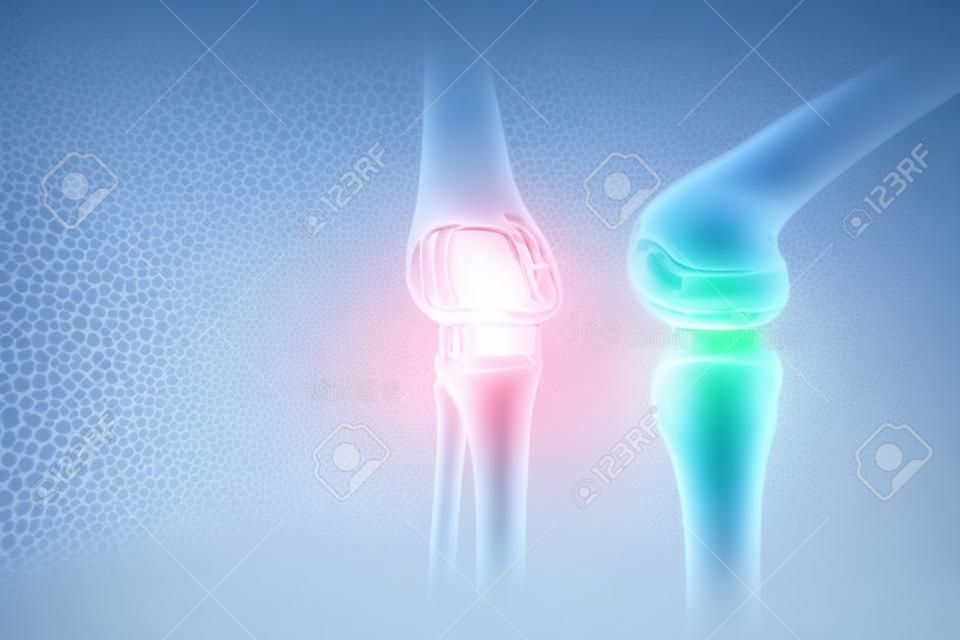 heupimplantaat Medische poster, afbeelding van de botten van de knie, kunstgewricht in de knie. Artritis, ontsteking, breuk, kraakbeen,. Kopieruimte, 3D illustratie, 3D render