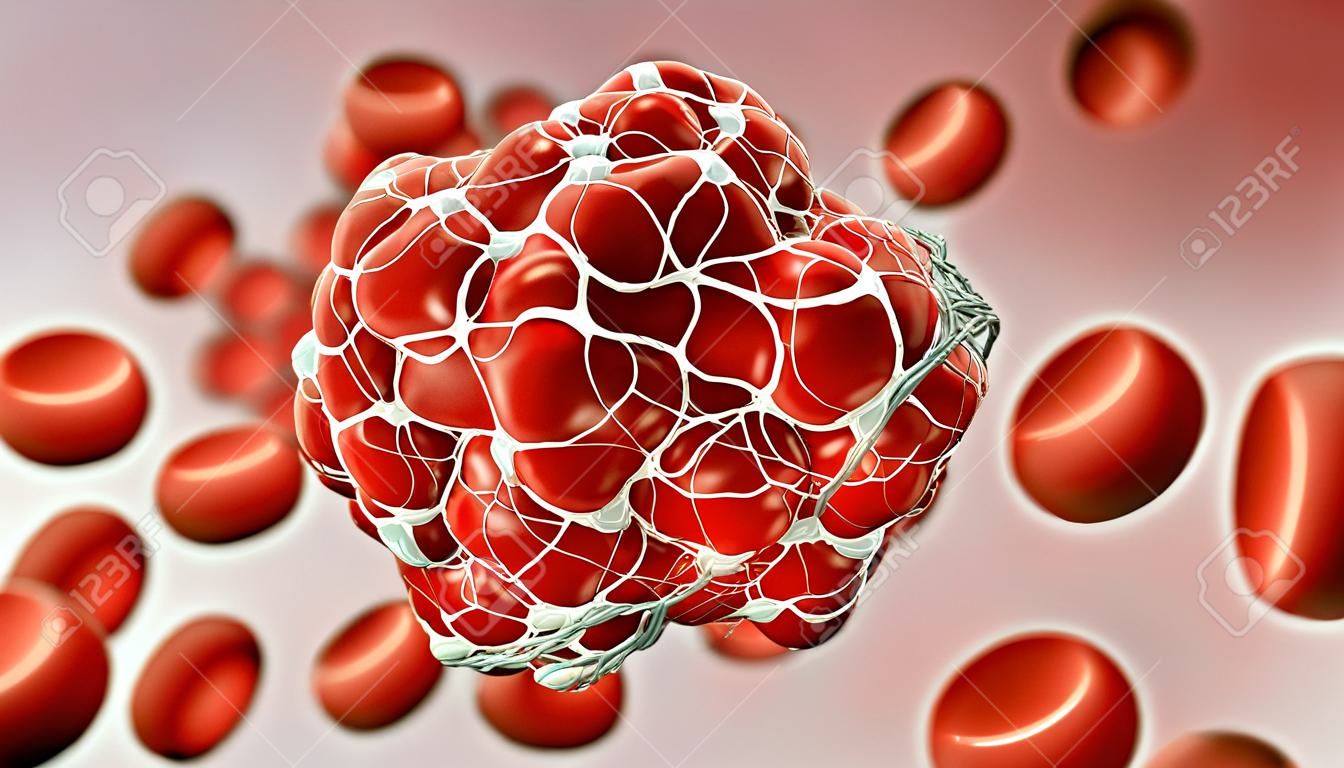 Close-up of a coagulated clot of red blood cells entangled in fibrin 3D rendering illustration.