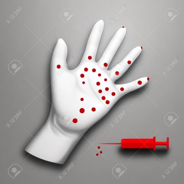 Illustration of a red dot on the hand. Of chicken pox