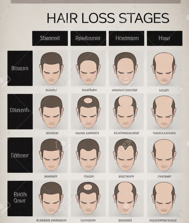 Information chart of hair loss stages and types of baldness illustrated on a male head.