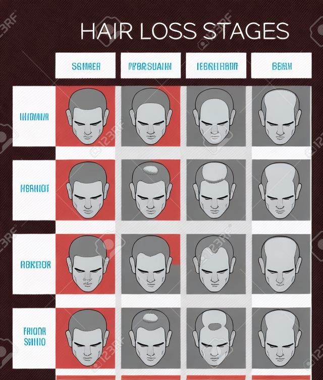 Cuadro de información de las etapas de la pérdida del cabello y la calvicie de tipo ilustrado en una cabeza masculina.