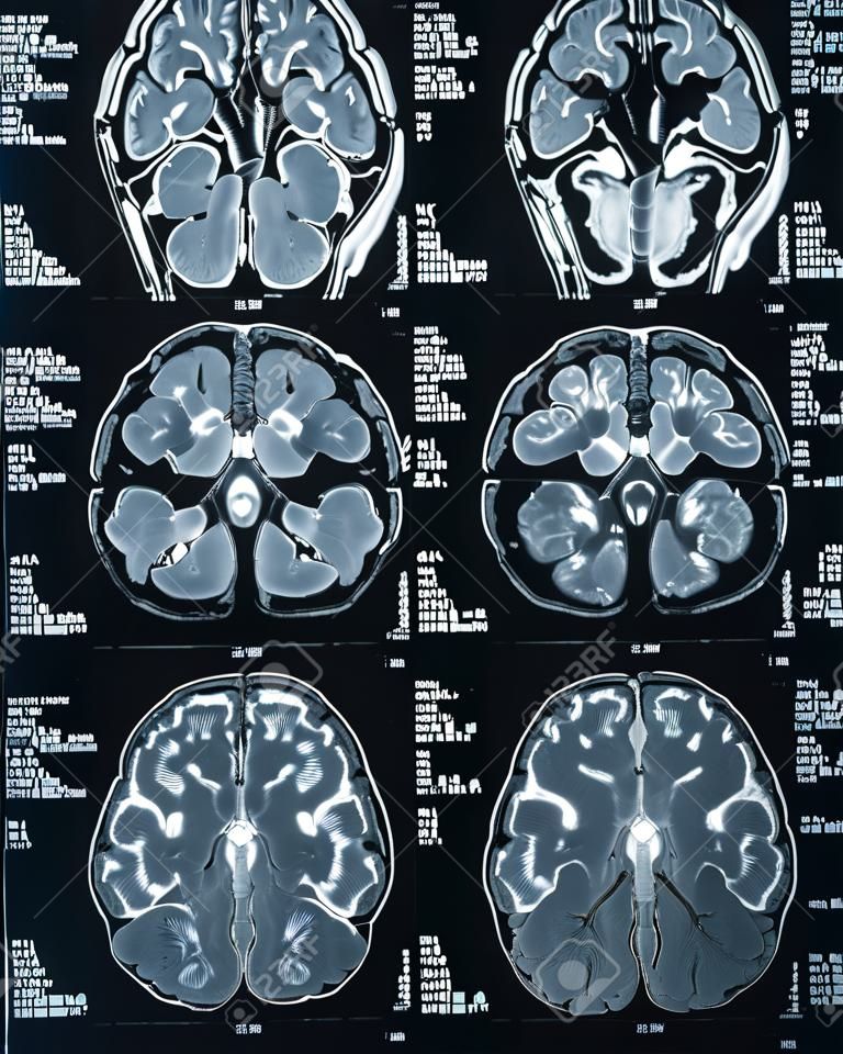 Exame de ressonância magnética do cérebro. Medicina e Saúde