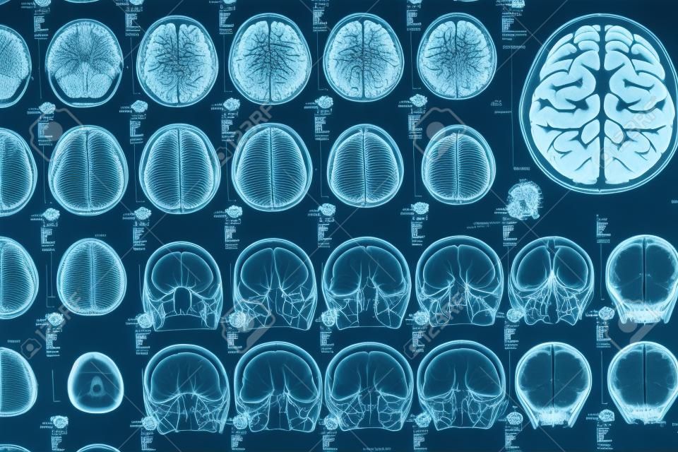 La radiographie de l'image gros plan du cerveau humain