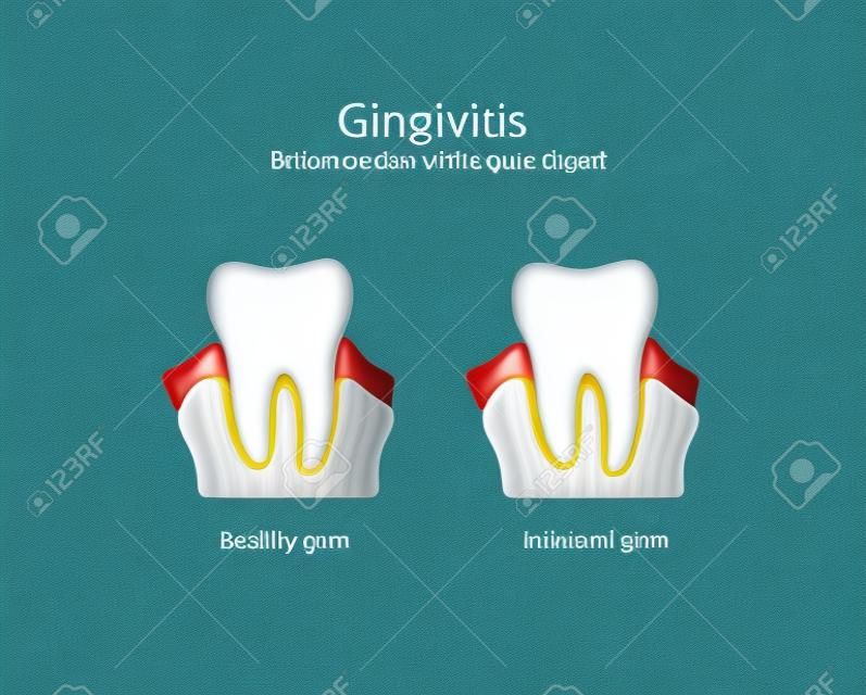 illustartion of gingivitis