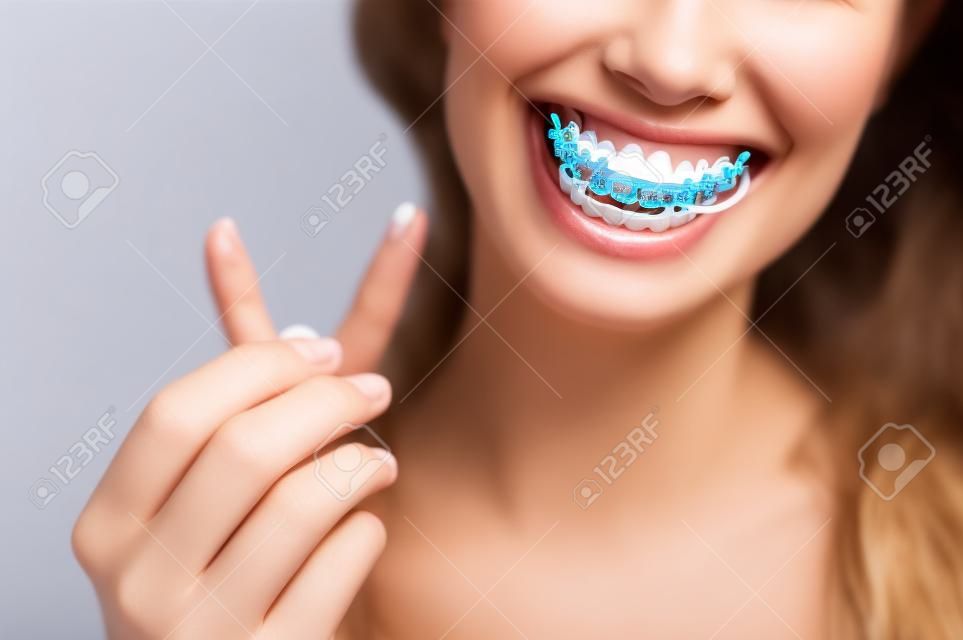 Primo piano dell'allineatore di denti trasparente in silicone ortodontico in mani femminili. Una donna con un sorriso di fascino perfetto tiene in mano un fermo notturno rimovibile. Staffa per lo sbiancamento dei denti. Foto ritagliata.