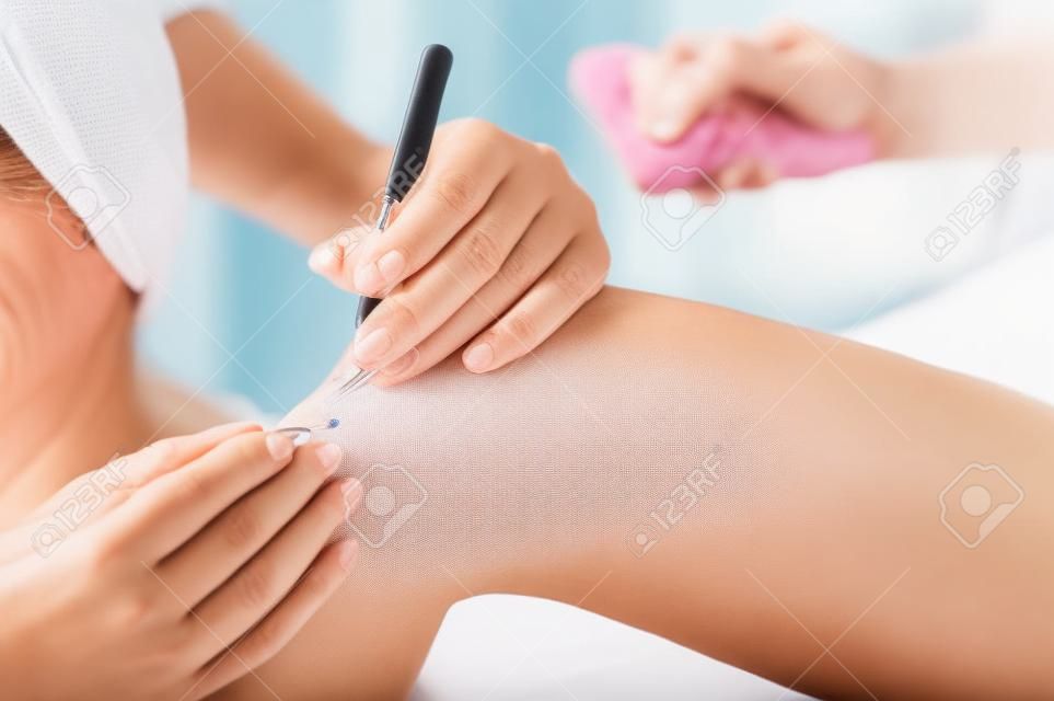 Close-up of electro epilation on the leg. The doctor removes unwanted hair from the patient with an electric device and tweezers