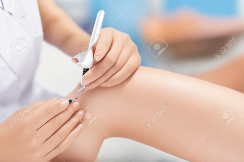 Close-up of electro epilation on the leg. The doctor removes unwanted hair from the patient with an electric device and tweezers