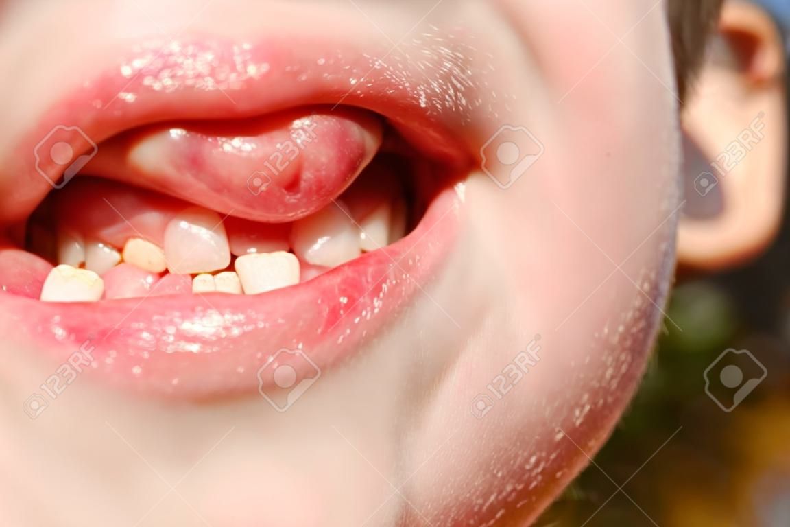 La inflamación en las encías del niño.