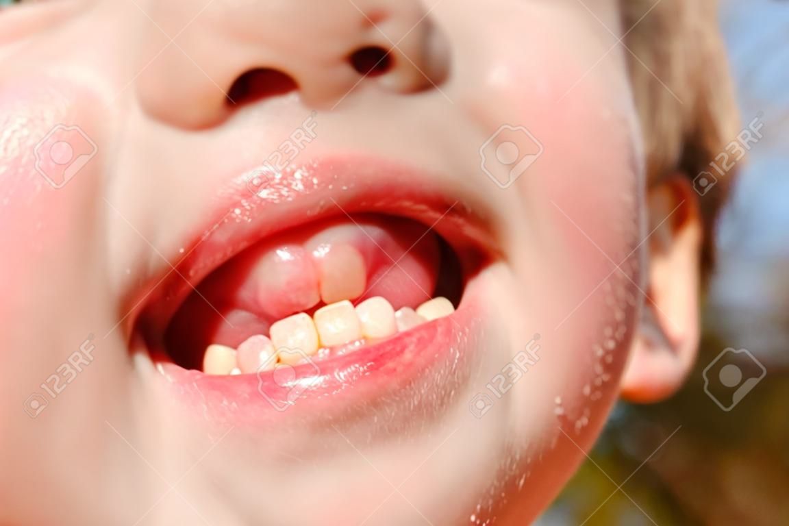 子供の歯茎の腫れ。