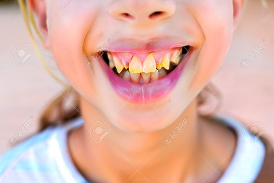 Placa dental em adolescente. Feche acima dos dentes amarelos.
