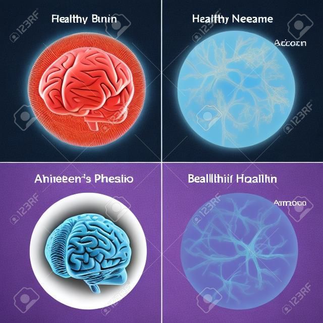 De patiënt en de hersenen gezonde hersenen en neuronen in vergelijking met de ziekte van Alzheimer. Amyloid Plaque.