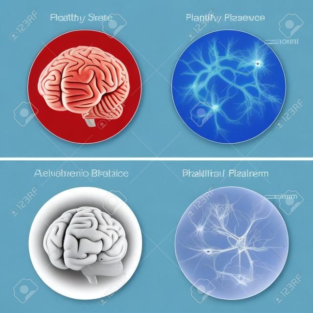 Der Patient und das Gehirn gesundes Gehirn und Nervenzellen im Vergleich. Alzheimer-Erkrankung. Amyloid- Plaque.