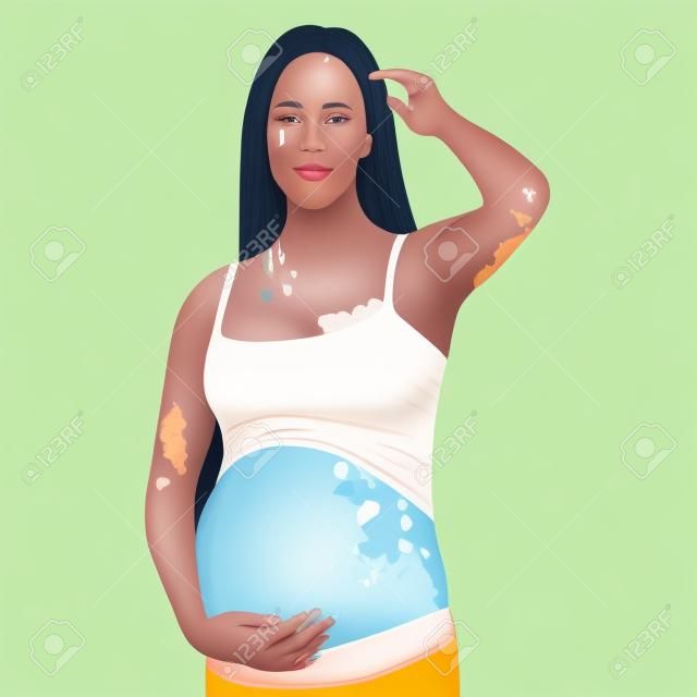 Junge schwangere Frau mit Vitiligo auf der Haut, Schönheitsvielfalt-Konzept, positive Selbstakzeptanz des Körpers, Bewusstsein für chronische Hautkrankheiten, Illustration