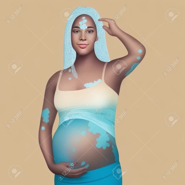 Young, pregnant woman with vitiligo on the skin. Beauty diversity concept, positive body, self-acceptance, awareness of chronic skin diseases, illustration