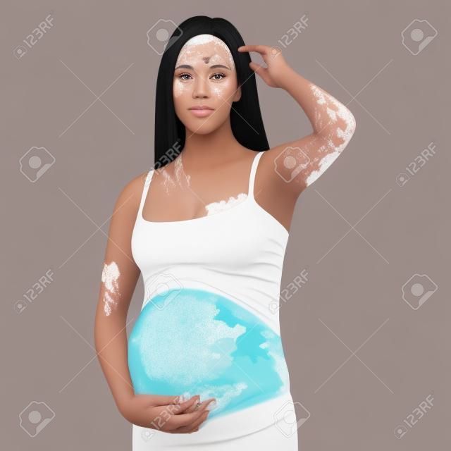 Mujer embarazada joven con vitíligo en el concepto de diversidad de belleza de la piel conciencia de autoaceptación corporal positiva de las enfermedades crónicas de la piel ilustración