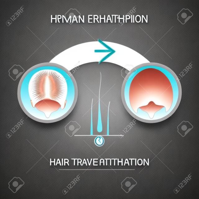 Przeszczep włosów dla kobiet - infografika 2 etapy.