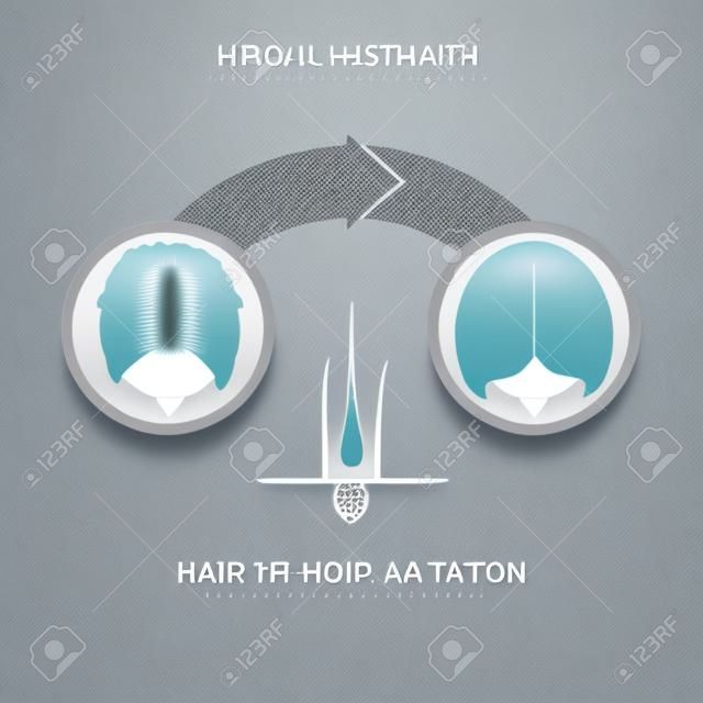 Haartransplantation für Frauen - 2-Stufen-Infografiken.