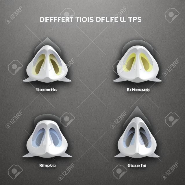 Verschillende soorten nasale tips