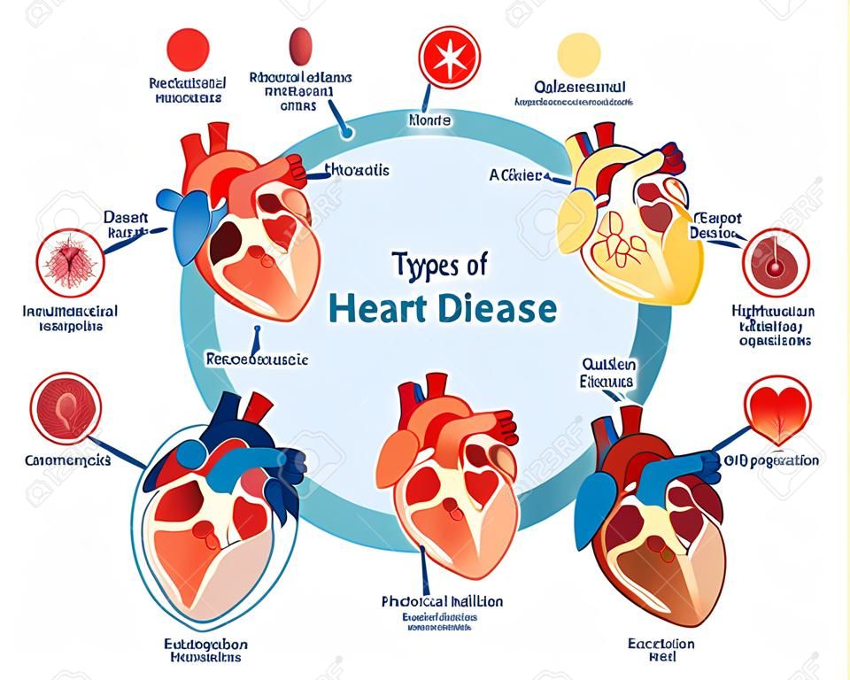 Tipi di raccolta delle malattie cardiache, diagramma dell'illustrazione di vettore. Informazioni mediche educative.