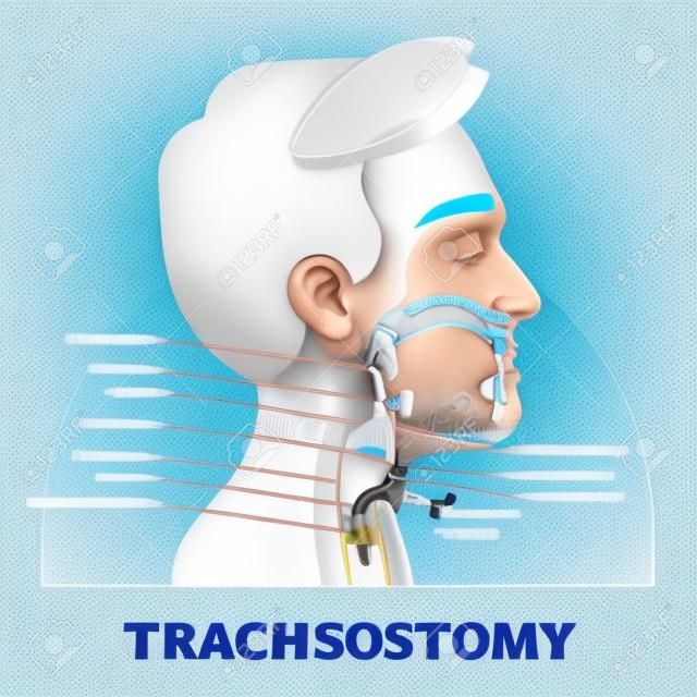 Tracheostomy cross section diagram, vector illustration labeled scheme. Intensive care unit equipment medical technology. Throat parts and tube location for breathing. Life assistance process setup.