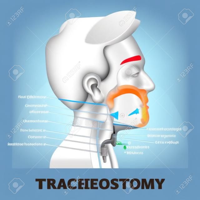 Tracheostomy cross section diagram, vector illustration labeled scheme. Intensive care unit equipment medical technology. Throat parts and tube location for breathing. Life assistance process setup.