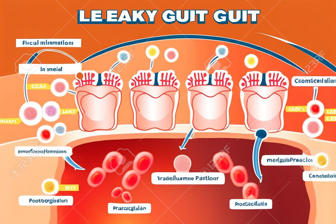 Leaky gut syndrome as medical chronic inflammation condition explanation. Labeled autoimmune health problem with transcellular and paracellular pathogens penetration in bloodstream vector illustration