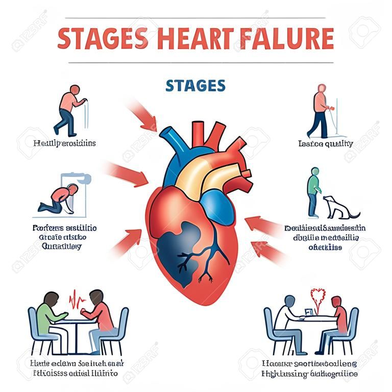 Stages of heart failure and symptoms with cardiology stroke outline diagram