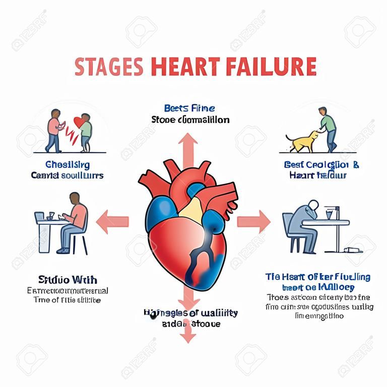 심장학 뇌졸중 개요도가 있는 심부전 및 증상의 단계