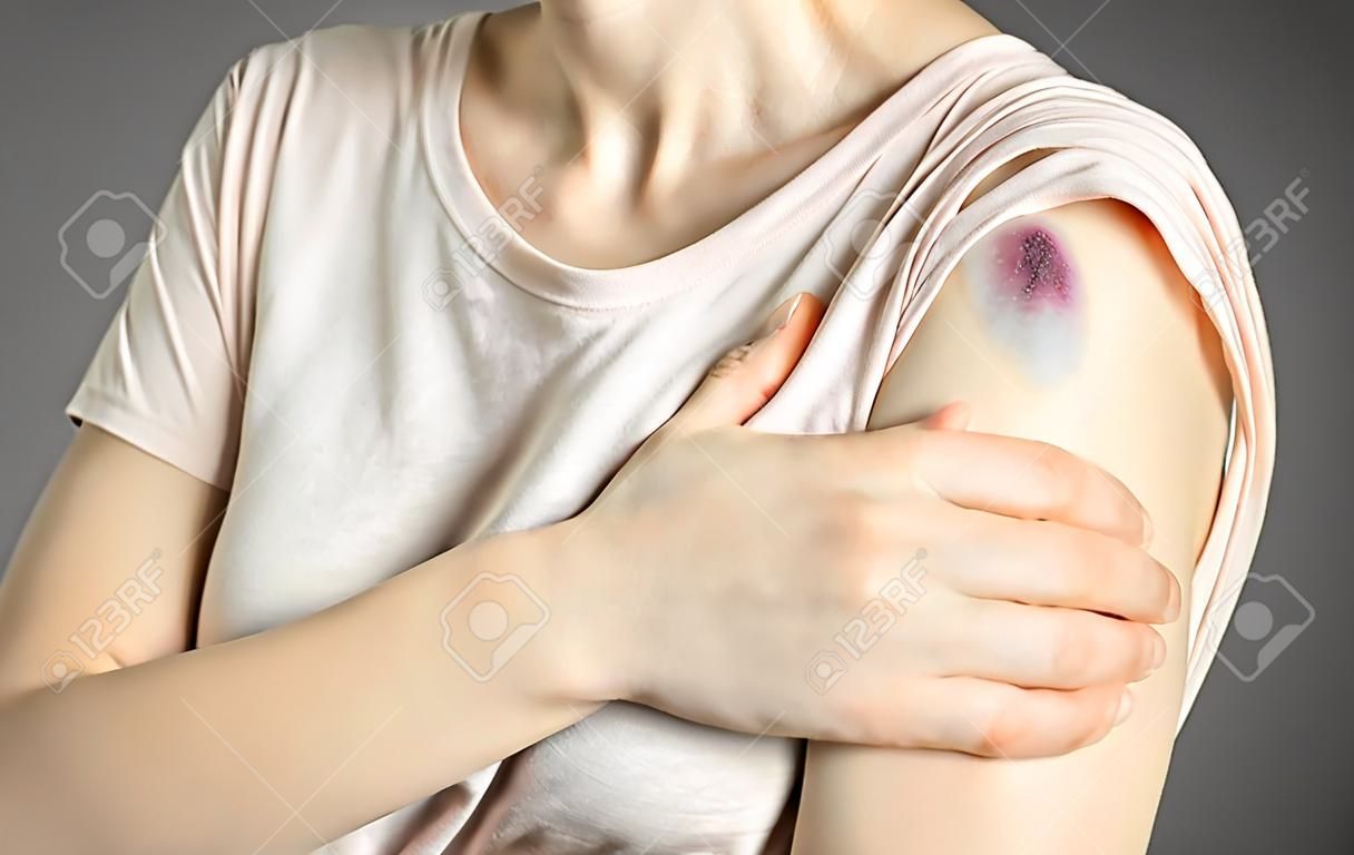 The bruise on his shoulder. Shoulder pain. The woman holds her hand. Close up.