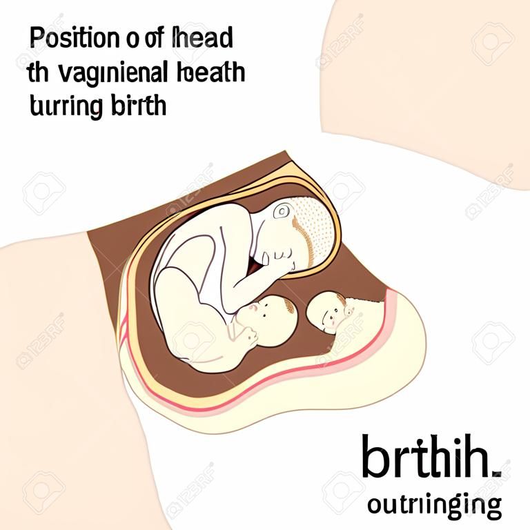 Posición de la cabeza del bebé durante un parto vaginal