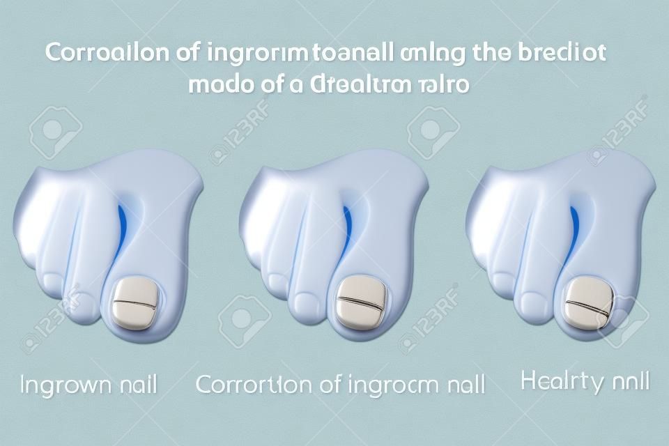 Correction of ingrown nail