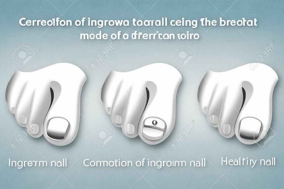 Correction of ingrown nail