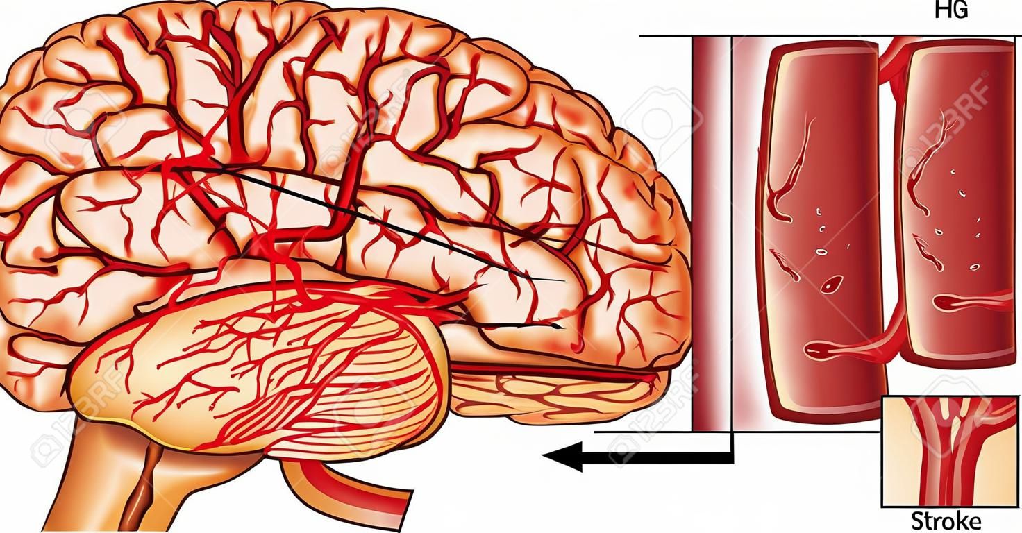 Cervello Illustrazione Stroke. Un esempio di ictus emorragico.