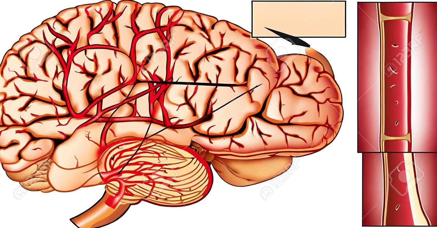 Cervello Illustrazione Stroke. Un esempio di ictus emorragico.