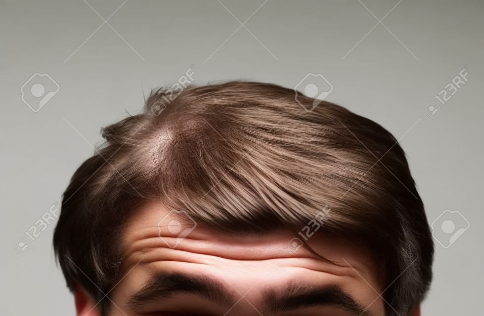 perda de cabelo, cabeça masculina com sintomas de perda de cabelo