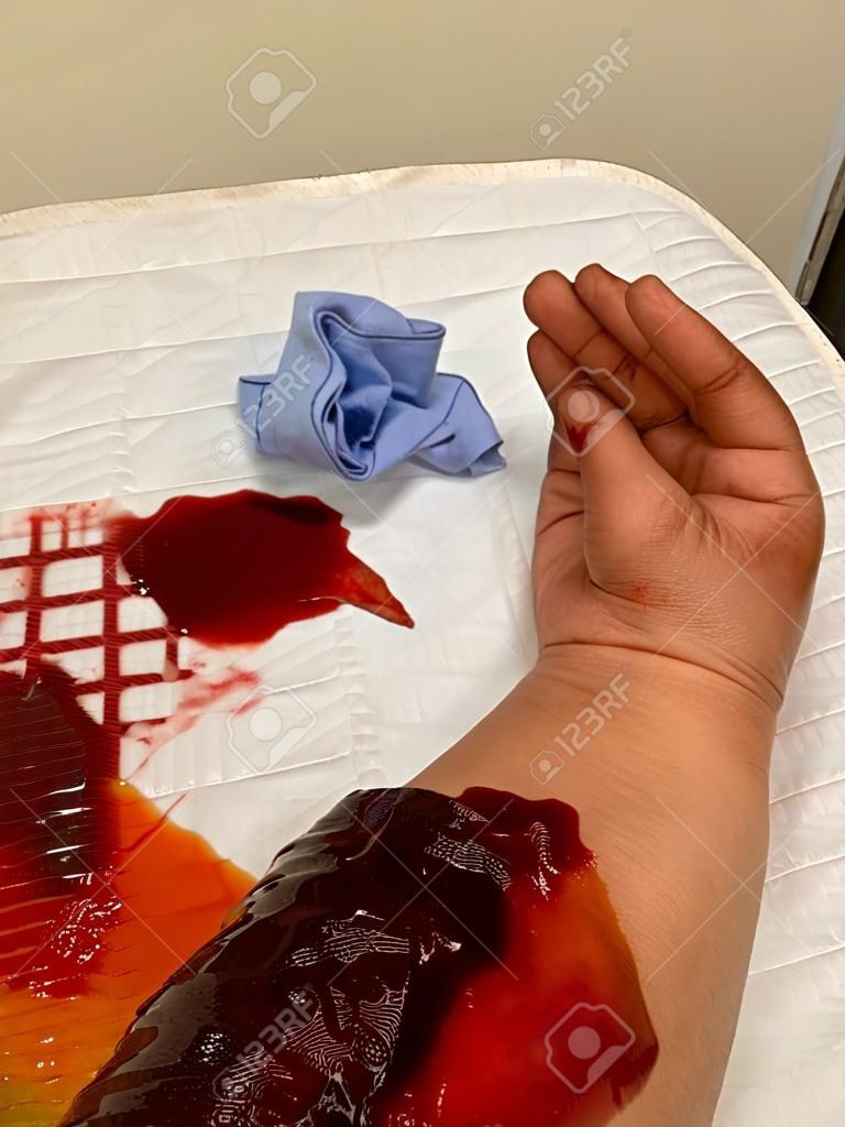 Mão sangrenta cortada por serra na mão ferida após acidente no trabalho na oficina de carpintaria.