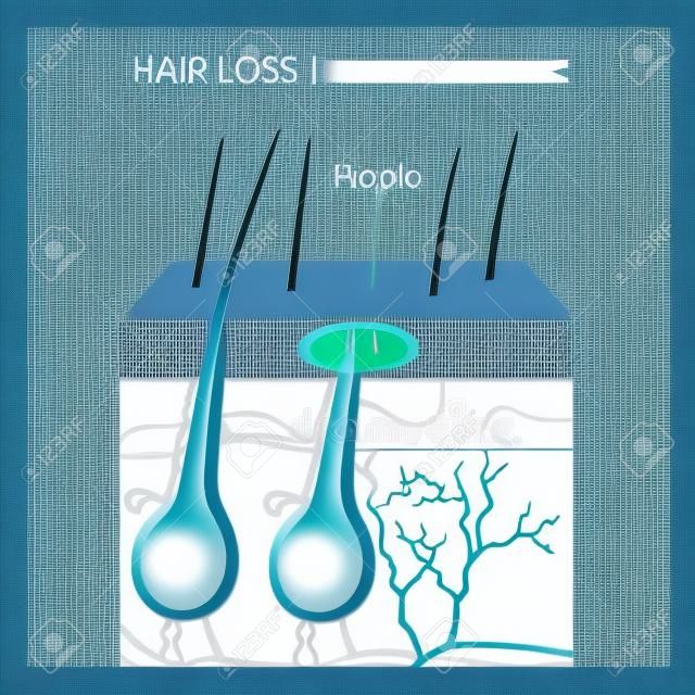 Illustration vectorielle de structure de perte de cheveux