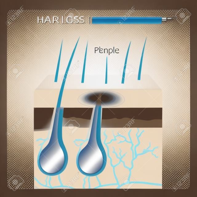 Hair Loss Structure Vector Illustration
