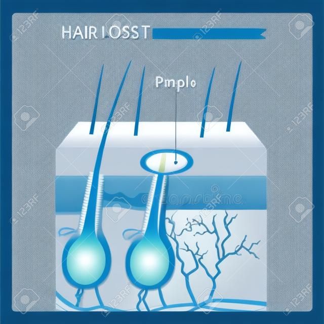 Ilustración de Vector de estructura de pérdida de cabello