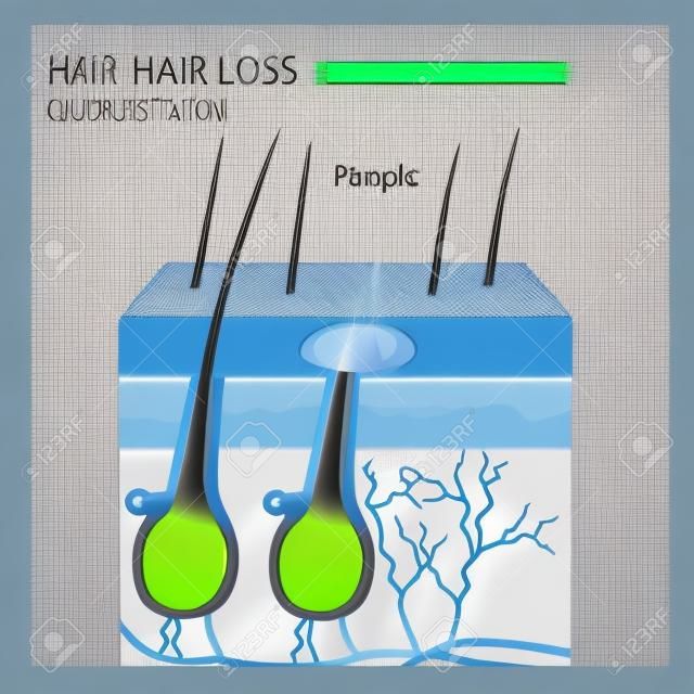 Illustration vectorielle de structure de perte de cheveux